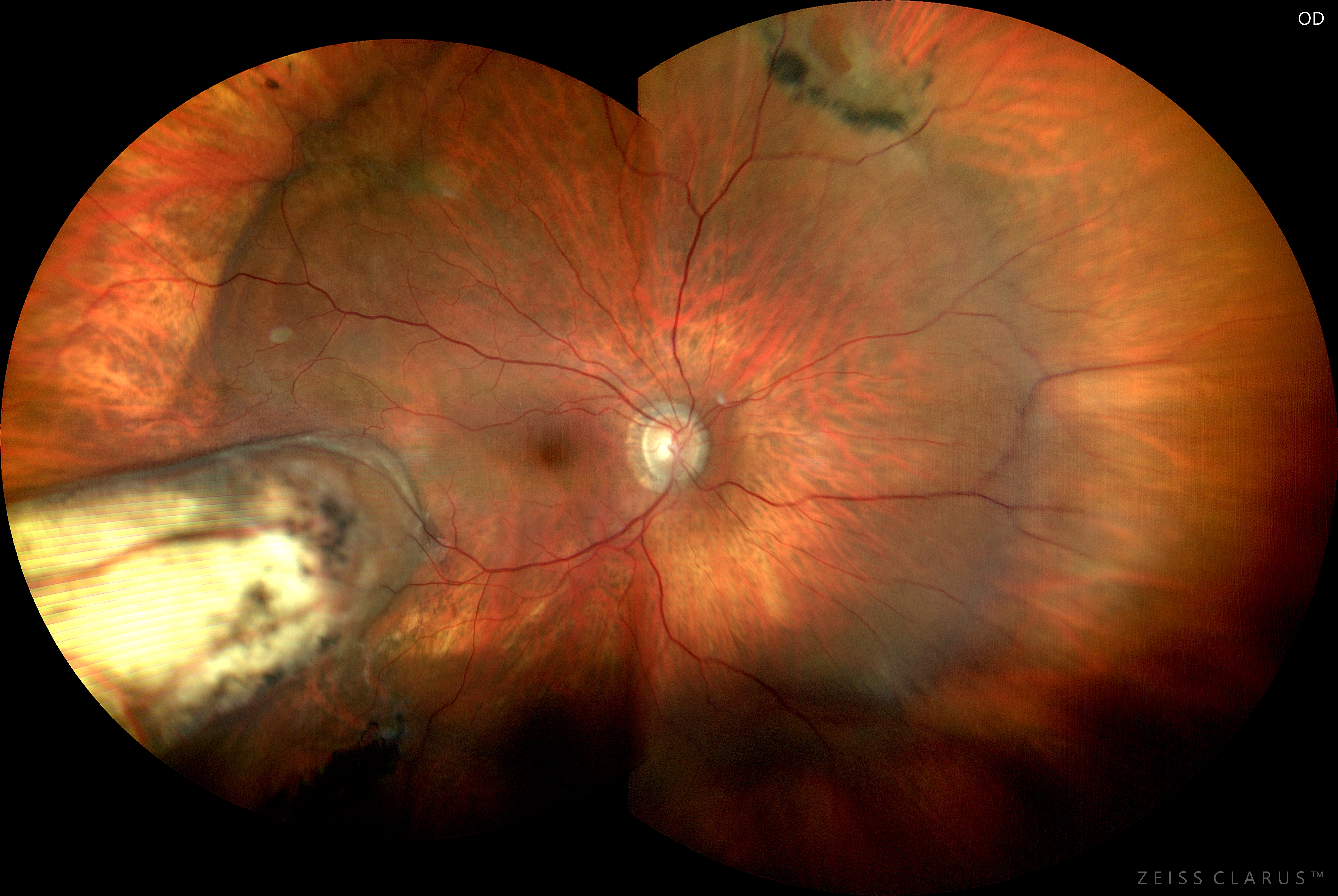 Imaging ad ampio campo di distacco retinico con cerchiaggio